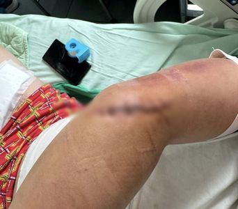 國道服務區驚魂夜！男子抽菸遭隨機砍傷，四肢重創肌腱斷裂