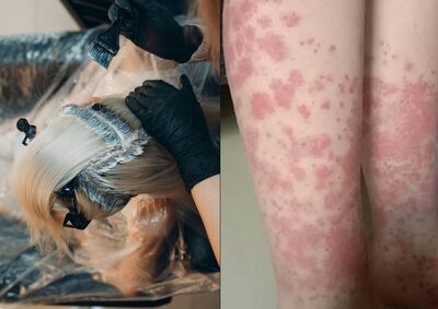 20歲愛美女每月染髮引發致命過敏：醫師剃光頭緊急救治