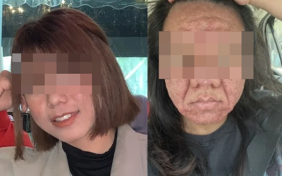懷孕8月女子驚覺容貌大變：滿臉痘痘皺紋，崩潰稱「變成另一個人」