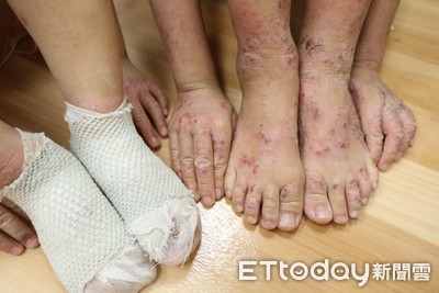 越來越多小孩中鏢!「過敏3兄弟」醫解析:85%在5歲前發病