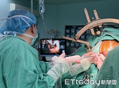 微創內視鏡手術創奇蹟：2公分傷口救回70歲腦出血婦人